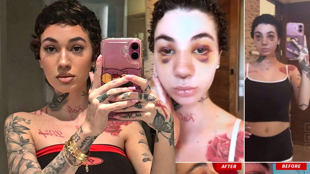 Bhad Bhabie Pamer Operasi Hidung, Ungkap Jenis Kanker yang Dideritanya