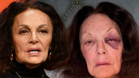 Desainer Diane von Furstenberg Menderita Mata Hitam Gnarly Setelah Musim Gugur