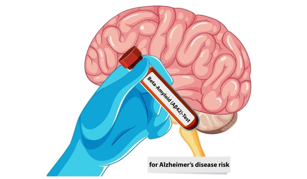 Penelitian Baru Penghapatan Plak Beta Amiloid Bisa Menunda Alzheimer