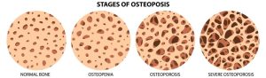 Tiga Langkah Bila Tubuh Alami Osteoporosis, Lakukan Skrining Lebih Awal